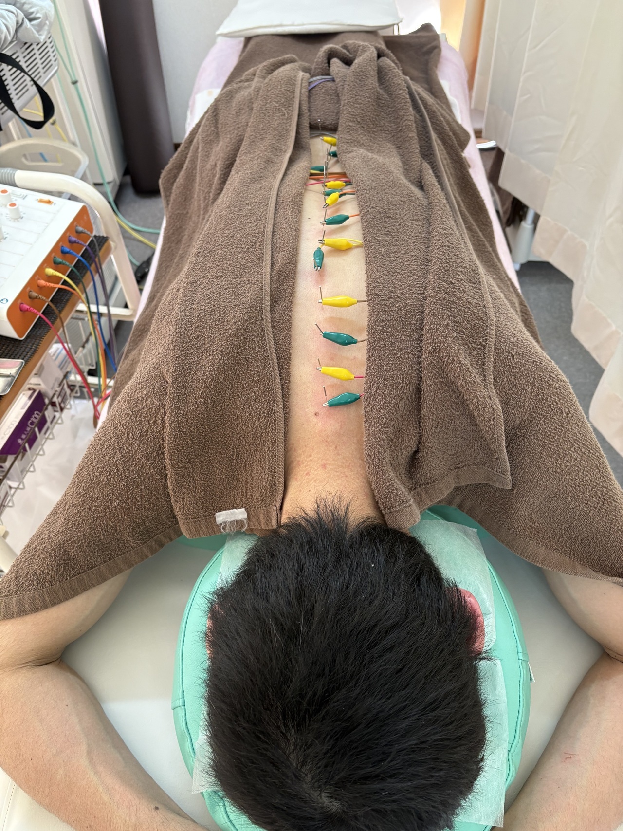 鍼通電　督脈パルス